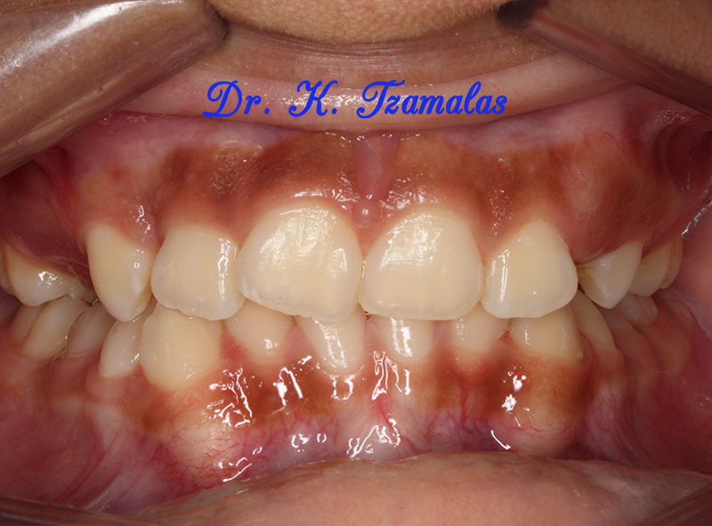 Athens Orthodontics - Dr. Κωνσταντίνος Τζαμάλας - Ορθοδοντικός Αθήνα